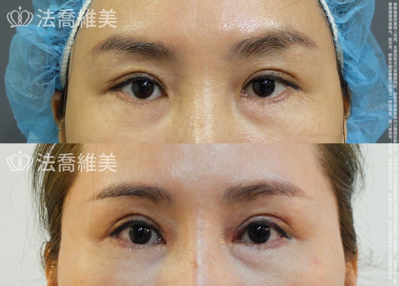 眼部手術