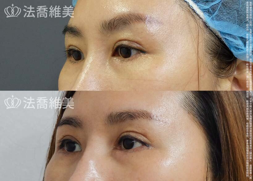 眼尾下置