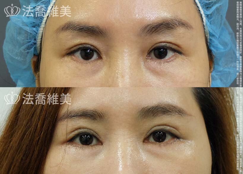 開眼頭