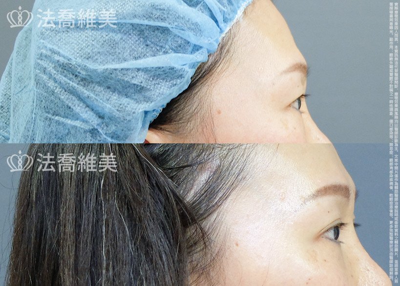 法喬醫美診所 邱浚彥醫師,縫雙眼皮