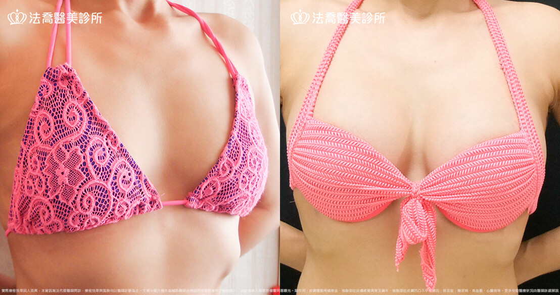 法喬醫美診所 邱浚彥醫師,複合式果凍矽膠隆乳