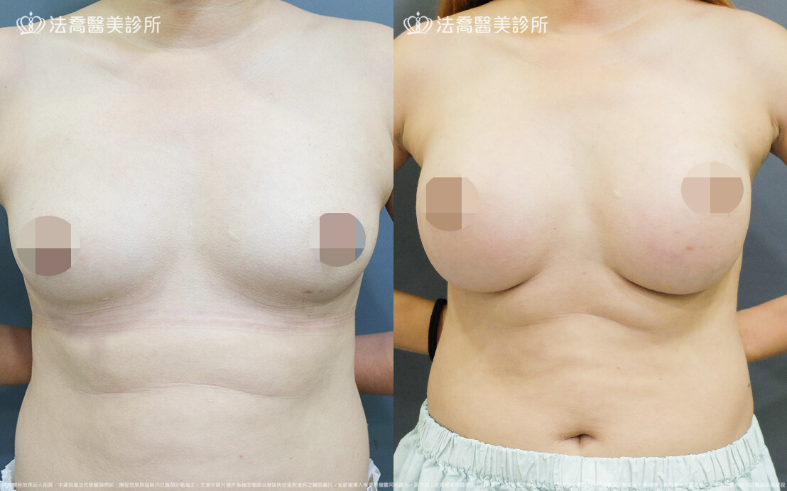 法喬醫美診所,邱浚彥,圓盤果凍矽膠隆乳