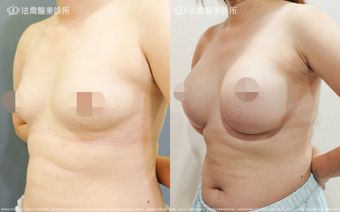 法喬醫美診所,邱浚彥,圓盤果凍矽膠隆乳