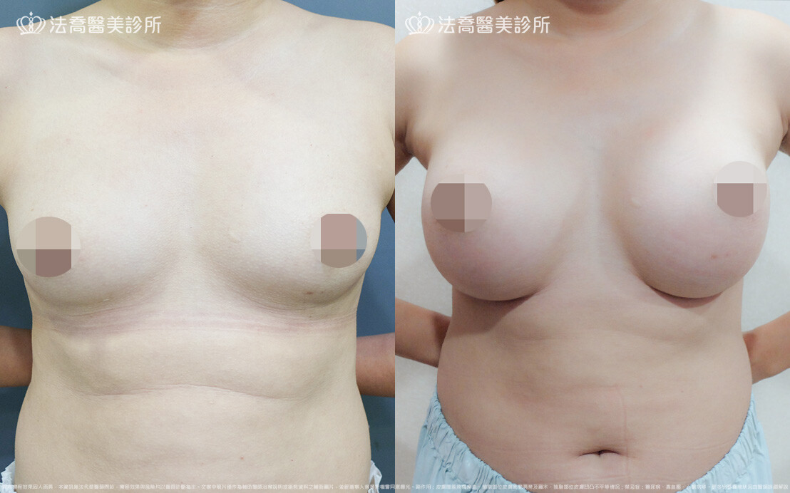 法喬醫美診所,邱浚彥,圓盤果凍矽膠隆乳