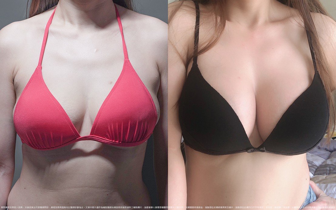 法喬醫美診所,邱浚彥,圓盤果凍矽膠隆乳