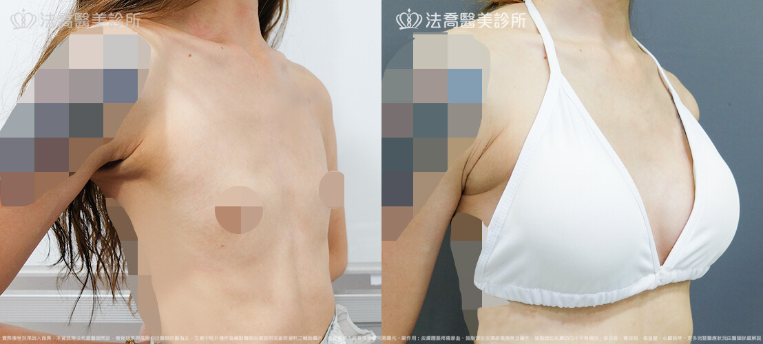 法喬醫美診所,邱浚彥,圓盤果凍矽膠隆乳