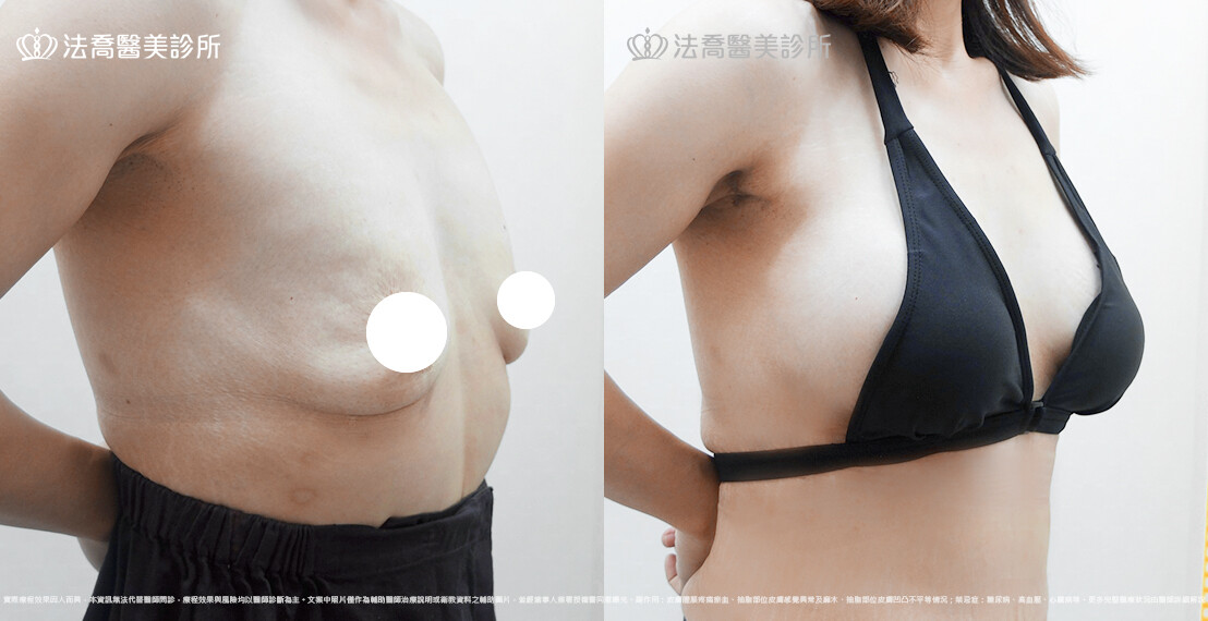 圓盤果凍矽膠隆乳