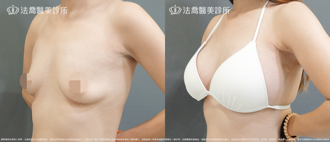 法喬醫美診所,邱浚彥,圓盤果凍矽膠隆乳