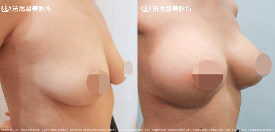 法喬醫美診所,邱浚彥,圓盤果凍矽膠隆乳