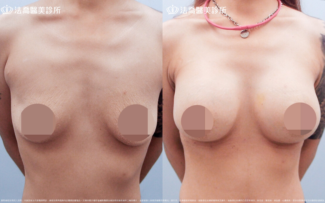 法喬醫美診所,邱浚彥,圓盤果凍矽膠隆乳