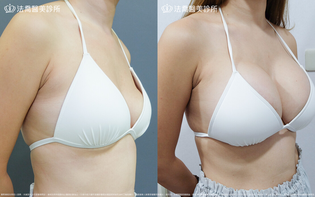 圓盤果凍矽膠隆乳