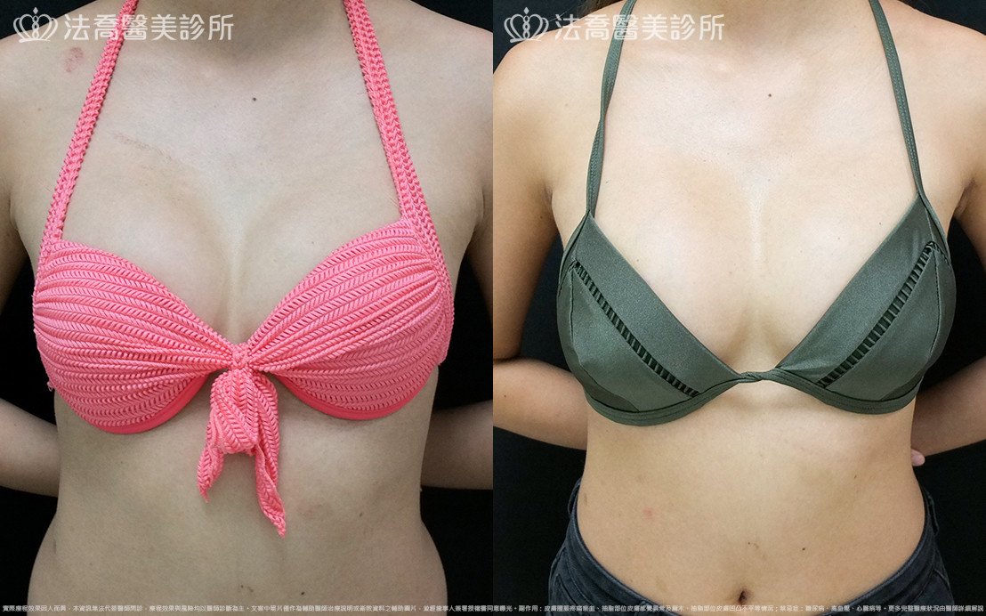 法喬醫美診所,邱浚彥,水滴果凍隆乳