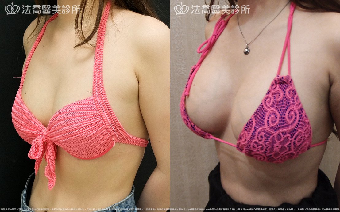 法喬醫美診所,邱浚彥,水滴果凍隆乳