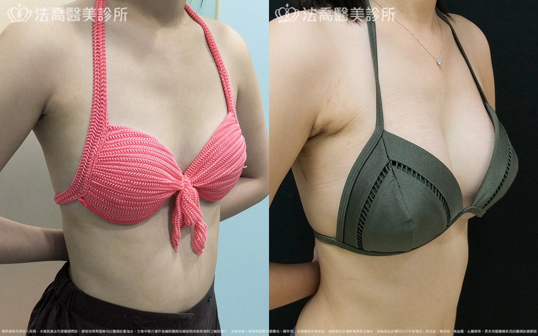 法喬醫美診所,邱浚彥,水滴果凍隆乳