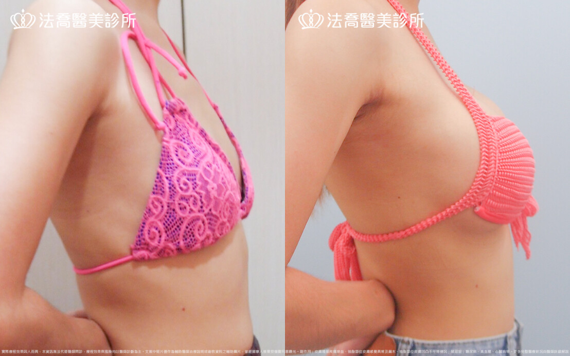 法喬醫美診所,邱浚彥,水滴果凍隆乳