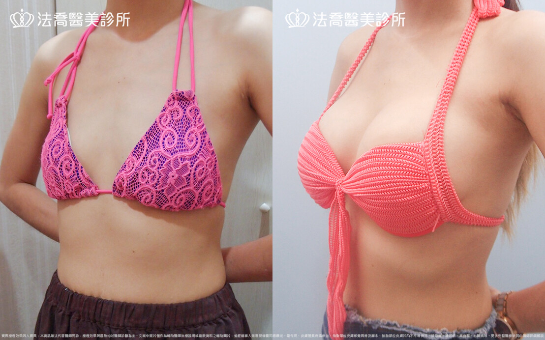 法喬醫美診所,邱浚彥,水滴果凍隆乳