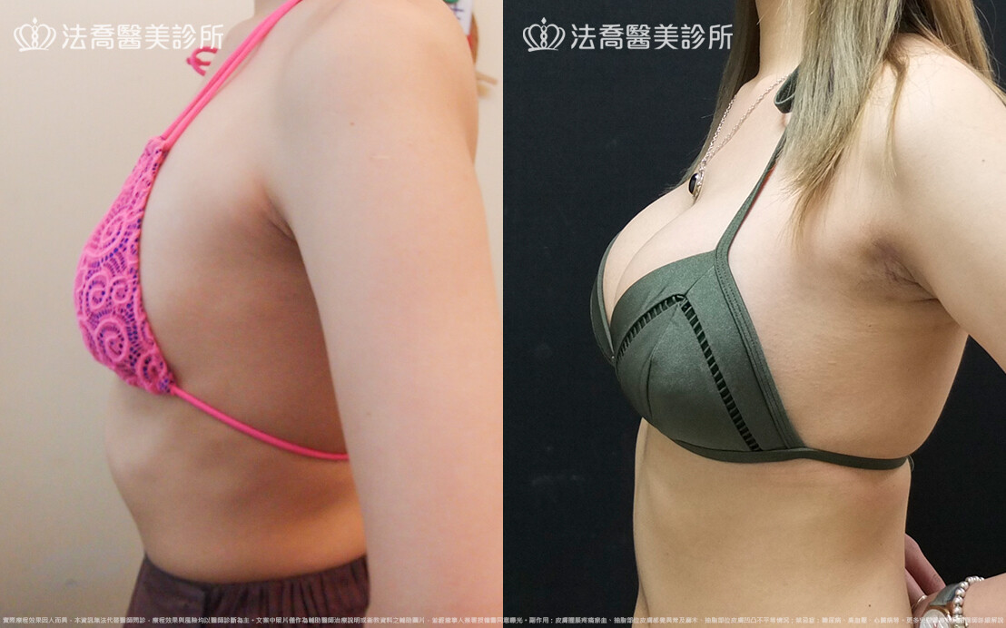 法喬醫美診所,邱浚彥,水滴果凍隆乳