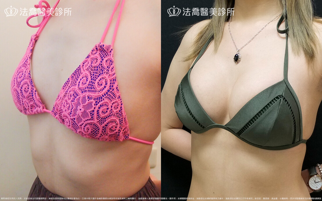 法喬醫美診所,邱浚彥,水滴果凍隆乳