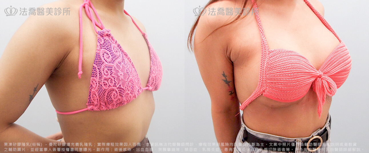 法喬醫美診所,邱浚彥,水滴果凍隆乳