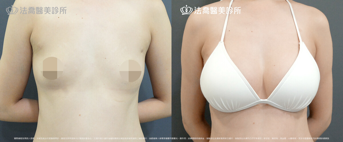豐胸