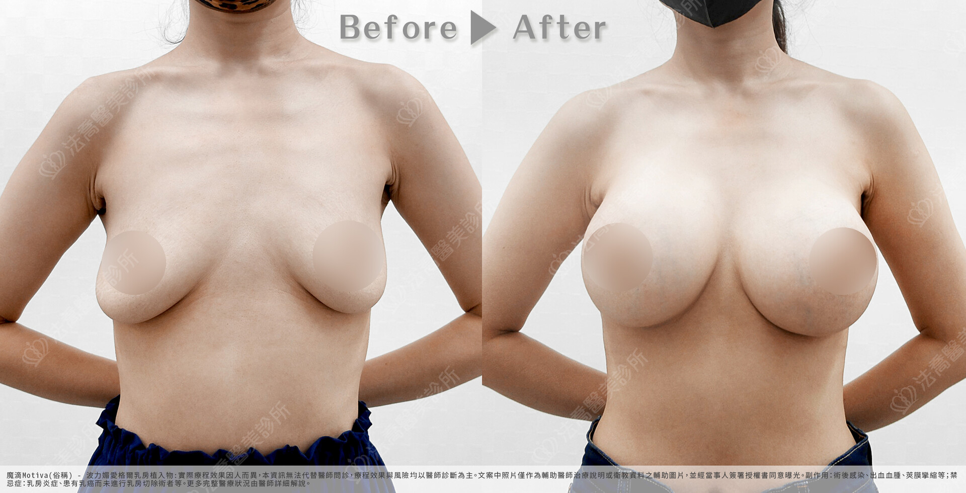 法喬醫美診所,魔滴隆乳