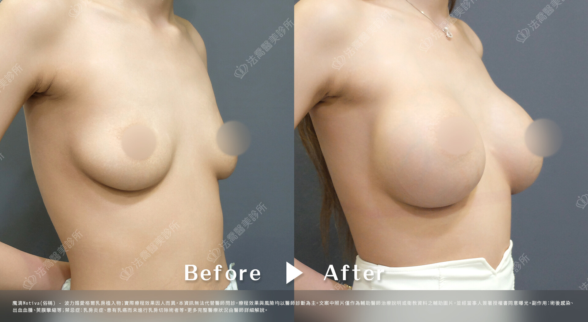 法喬醫美診所,魔滴隆乳