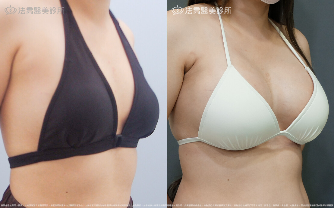 法喬醫美診所,邱浚彥,魔滴隆乳