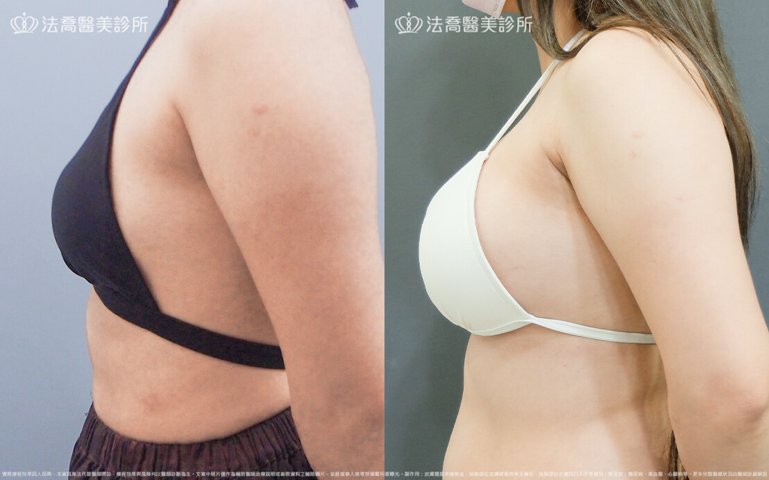 法喬醫美診所,邱浚彥,魔滴隆乳