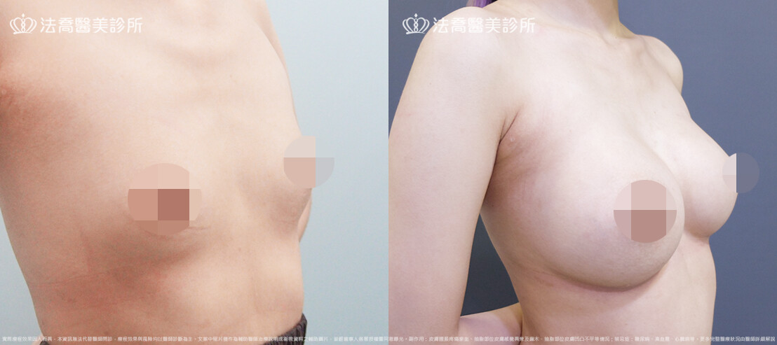 法喬醫美診所,邱浚彥,魔滴隆乳