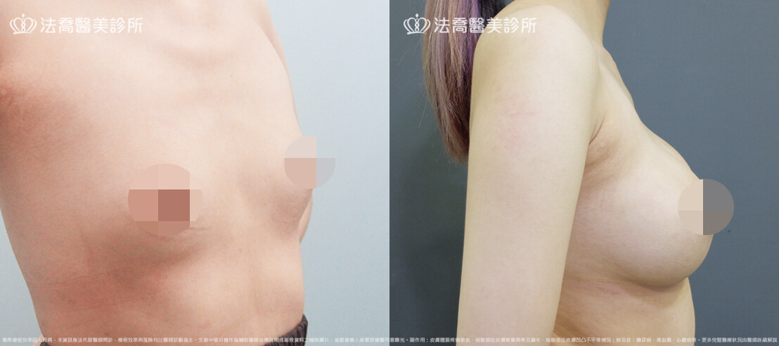 法喬醫美診所,邱浚彥,魔滴隆乳