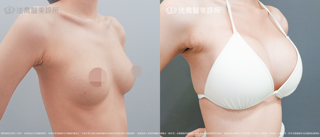 法喬醫美診所,邱浚彥,魔滴隆乳