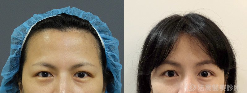 法喬醫美診所,邱浚彥,內視鏡前額五爪拉皮