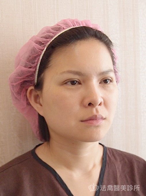 法喬醫美診所中下臉深部筋膜拉皮術後術前案例