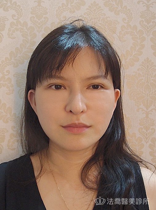 法喬醫美診所中下臉深部筋膜拉皮術後4個月案例