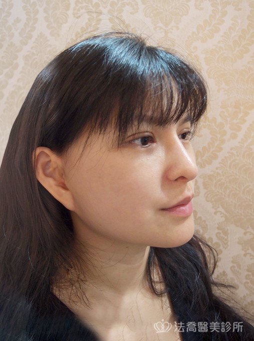 法喬醫美診所中下臉深部筋膜拉皮術後4個月案例