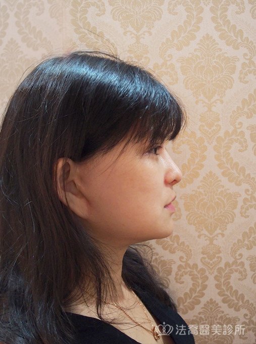 法喬醫美診所中下臉深部筋膜拉皮術後4個月案例
