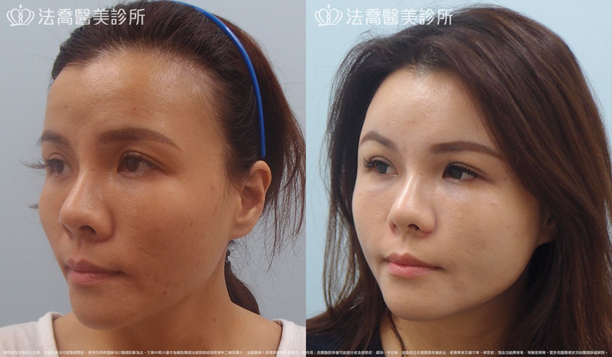 法喬醫美診所,邱浚彥,內視鏡前額五爪拉皮