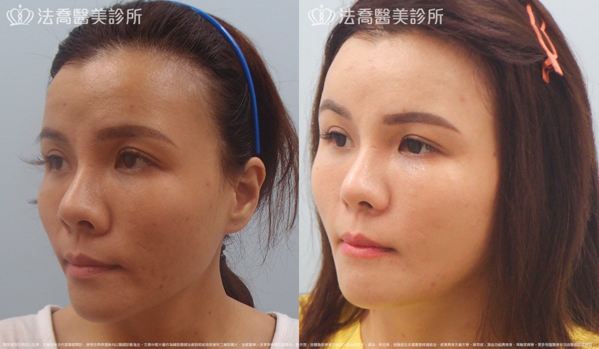 法喬醫美診所,邱浚彥,內視鏡前額五爪拉皮