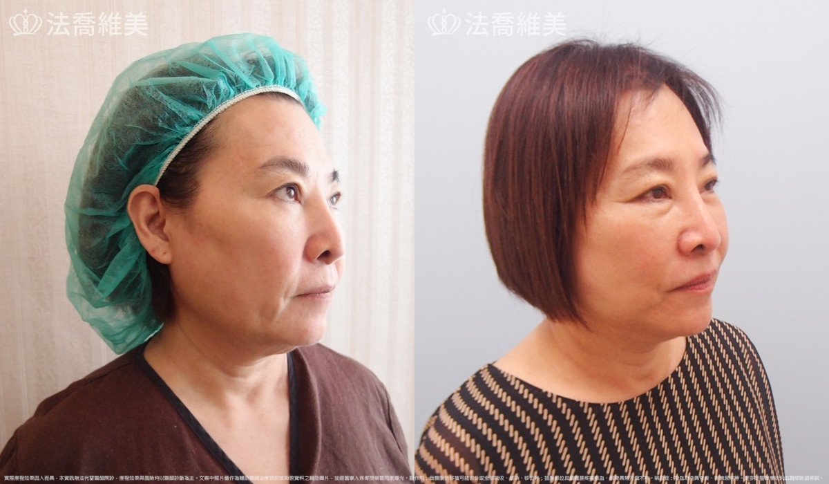 中下臉深部筋膜拉皮,法喬醫美診所,邱浚彥