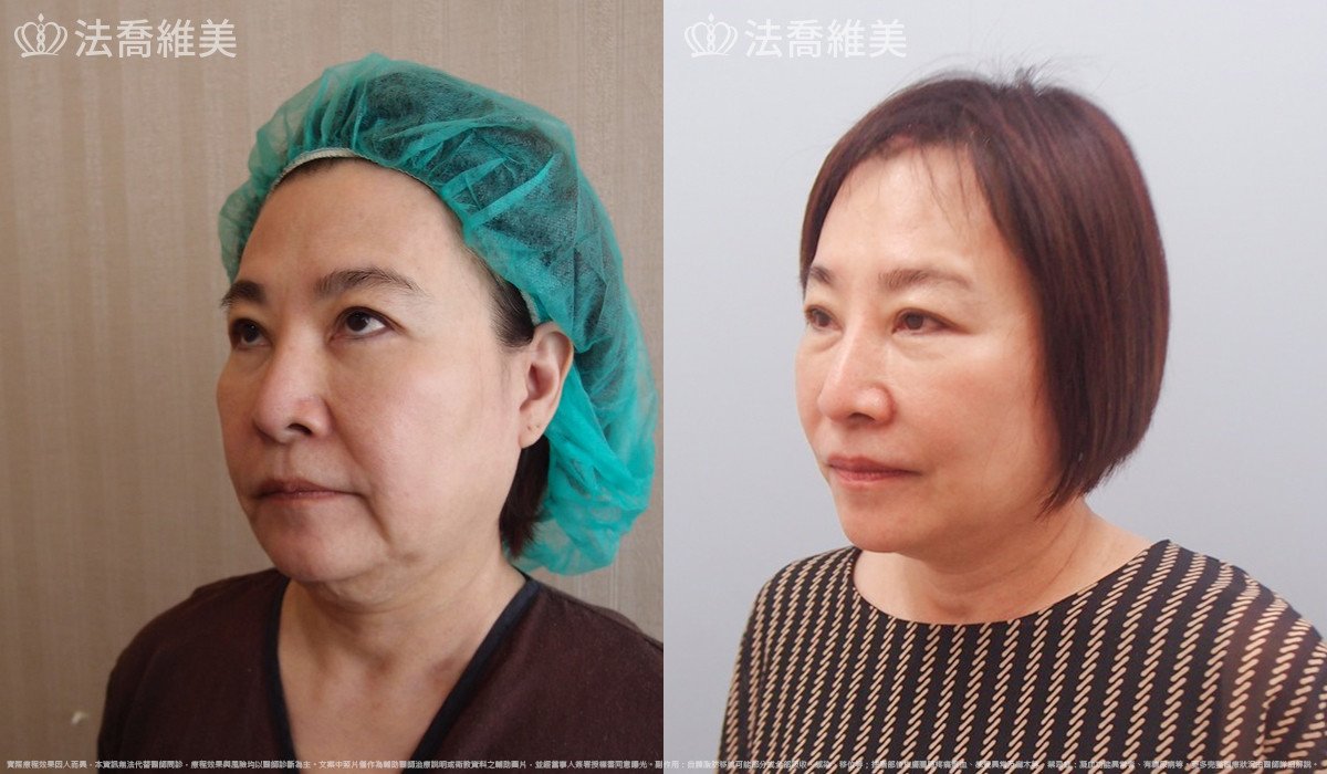 中下臉深部筋膜拉皮,法喬醫美診所,邱浚彥