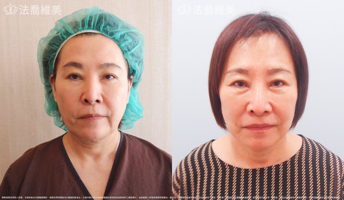 中下臉深部筋膜拉皮,法喬醫美診所,邱浚彥