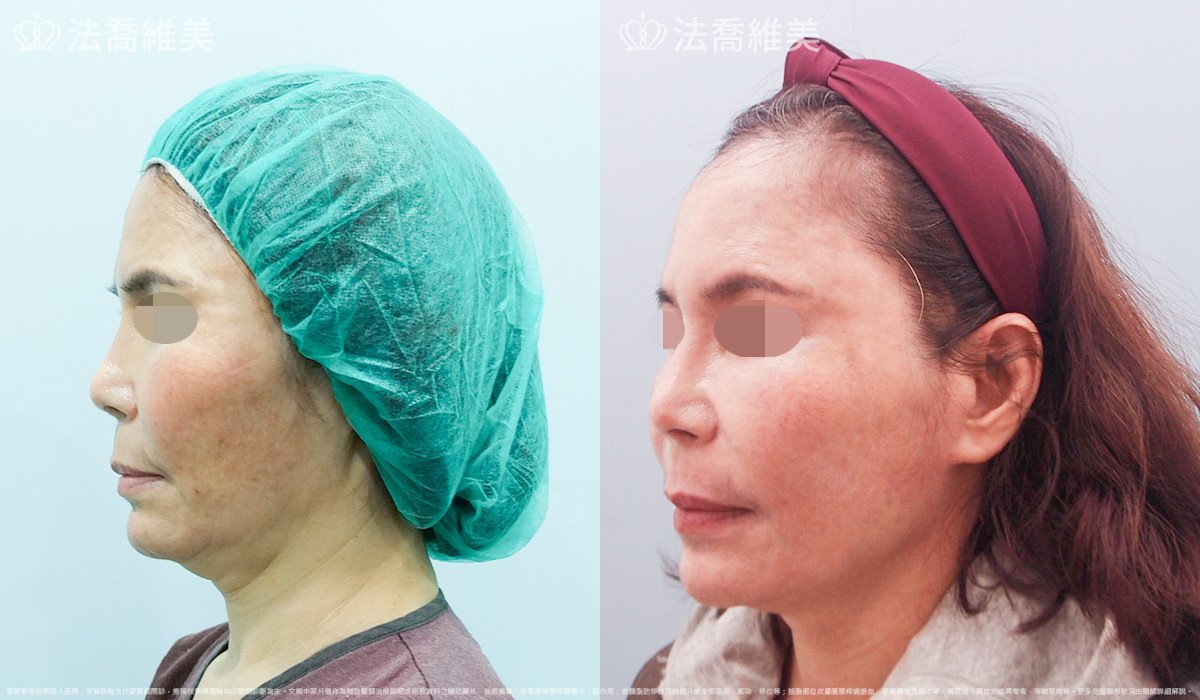 下臉深部筋膜拉皮,自體脂肪豐全臉,法喬醫美診所,邱浚彥