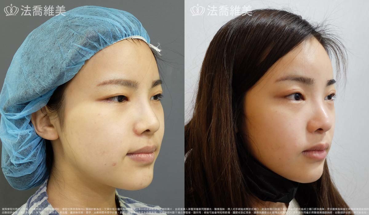 法喬醫美診所,邱浚彥,內視鏡前額五爪拉皮