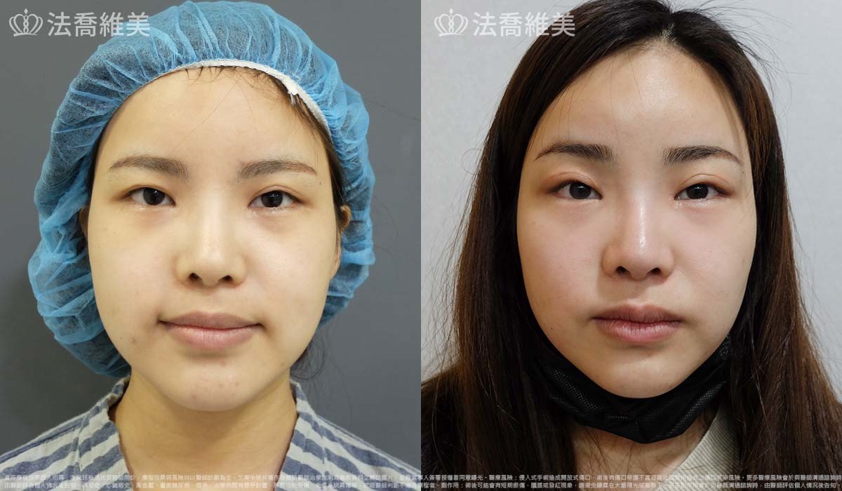法喬醫美診所,邱浚彥,內視鏡前額五爪拉皮