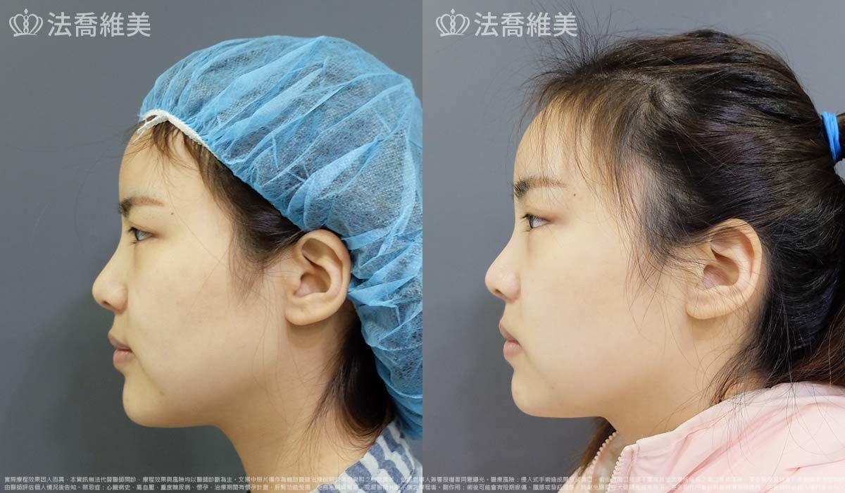 法喬醫美診所,邱浚彥,內視鏡前額五爪拉皮