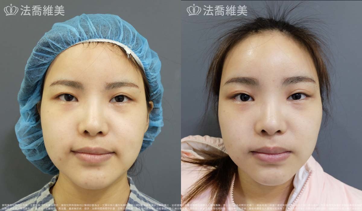 法喬醫美診所,邱浚彥,內視鏡前額五爪拉皮