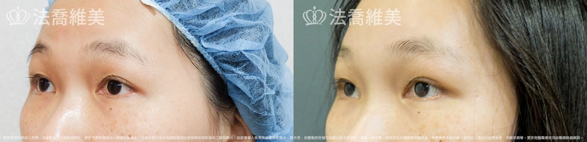 法喬醫美診所,邱浚彥,內視鏡前額五爪拉皮