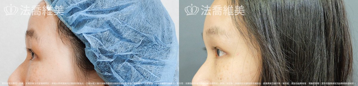 法喬醫美診所,邱浚彥,內視鏡前額五爪拉皮