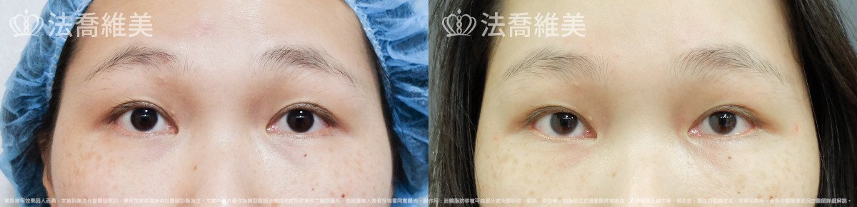 法喬醫美診所,邱浚彥,內視鏡前額五爪拉皮