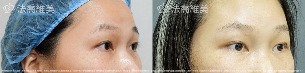 法喬醫美診所,邱浚彥,內視鏡前額五爪拉皮